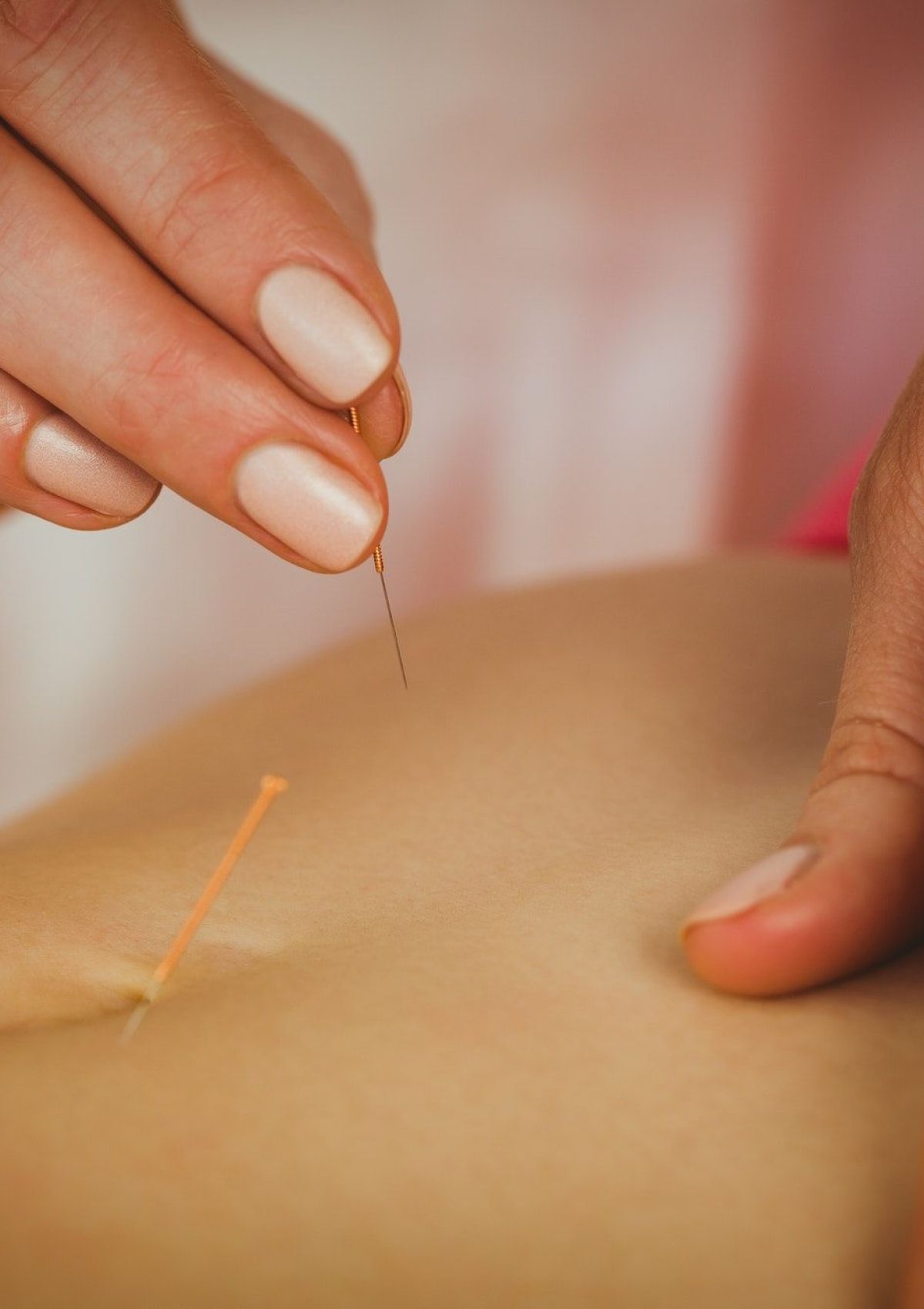 Young woman getting acupuncture treatment in therapy room